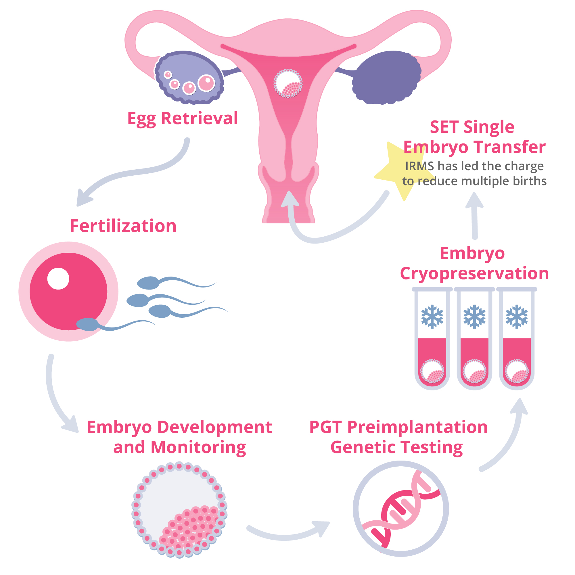 Graphic of how the Single Egg Transfer procedure works.